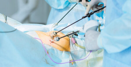 laparoscopy