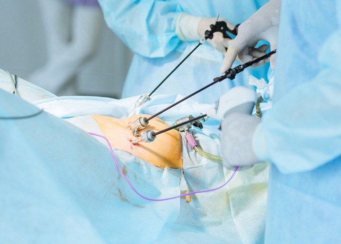 laparoscopy